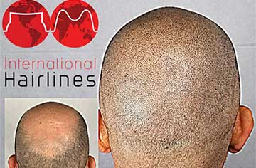 Scalp Micropigmentation